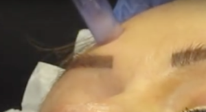 microdermabrasion