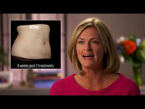 SculpSure® Laser Liposuction Patient Testimonials | Dr. Peña