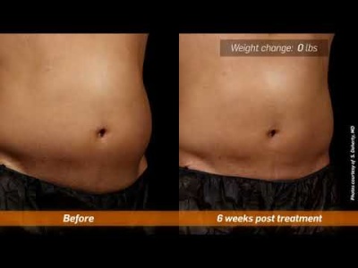 How does SculpSure Get Rid of Unwanted Body Fat?